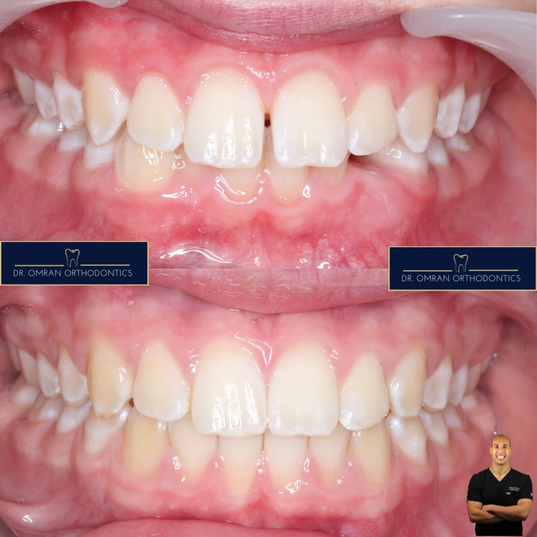 Deep bite and proclined upper incisors, 15 months