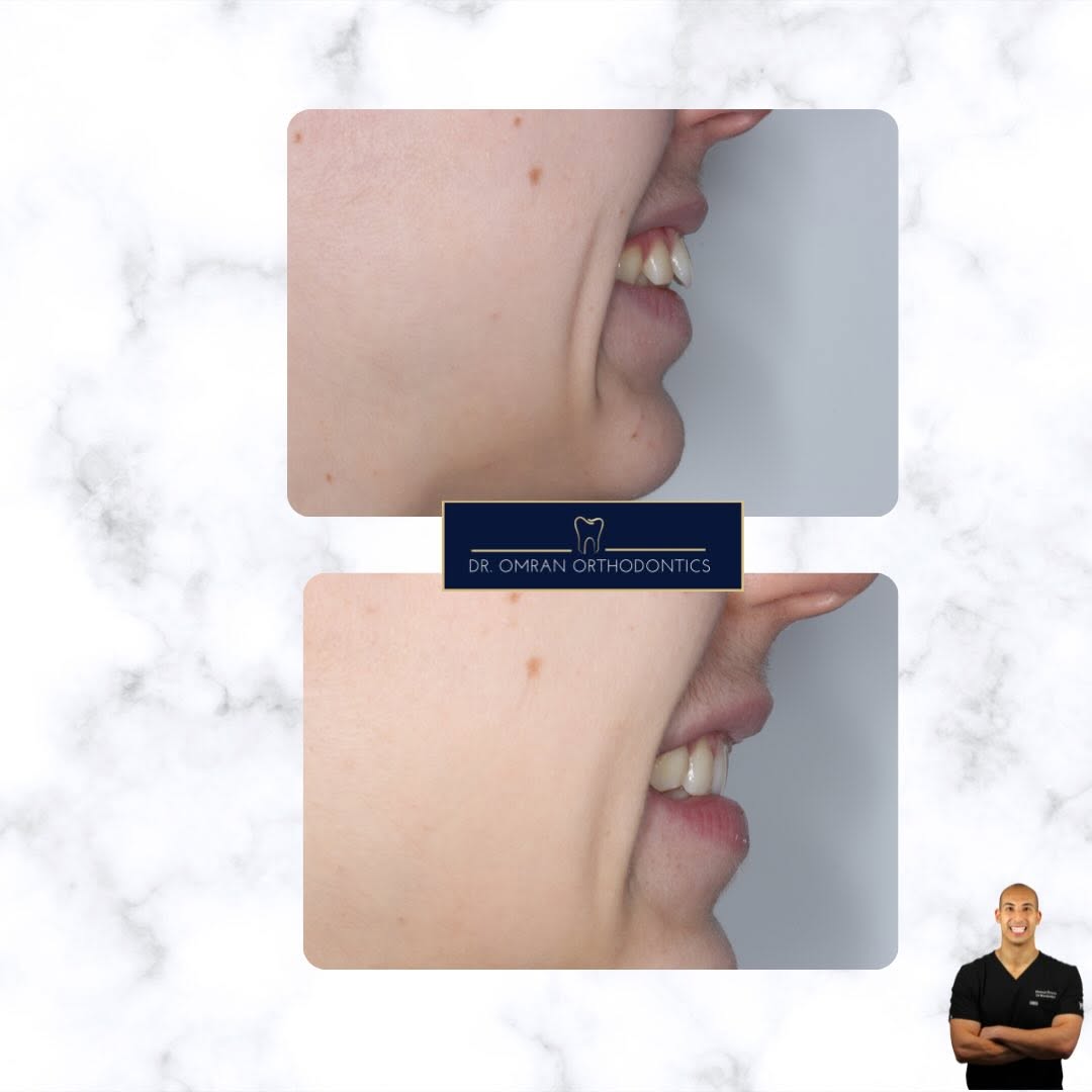 Proclined upper incisors