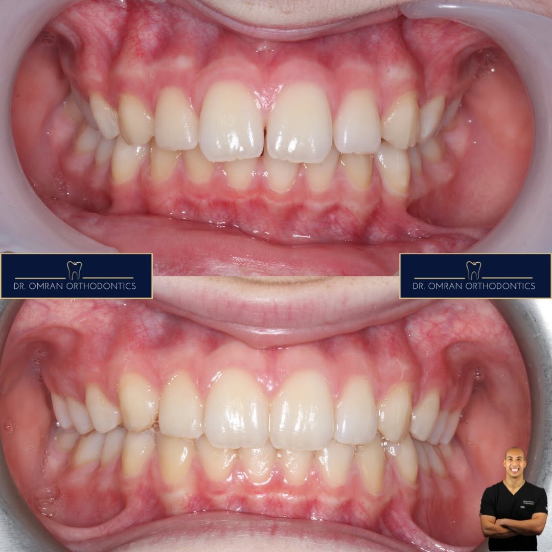Proclined upper incisors
