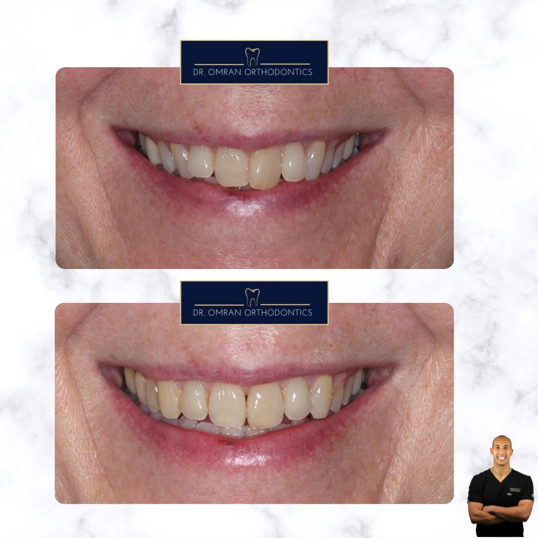 Canine and buccal segment correction