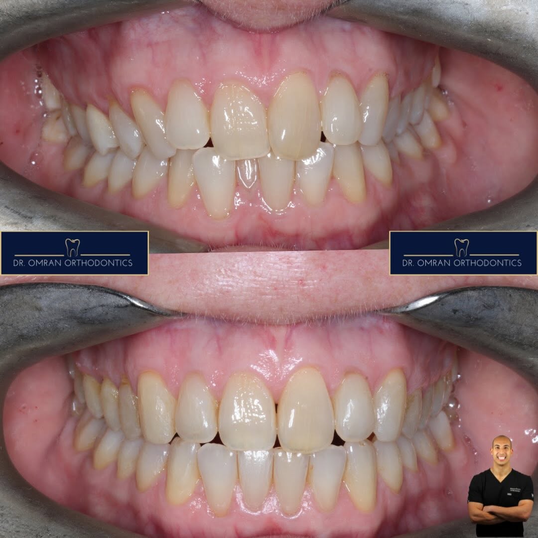 Canine and buccal segment correction