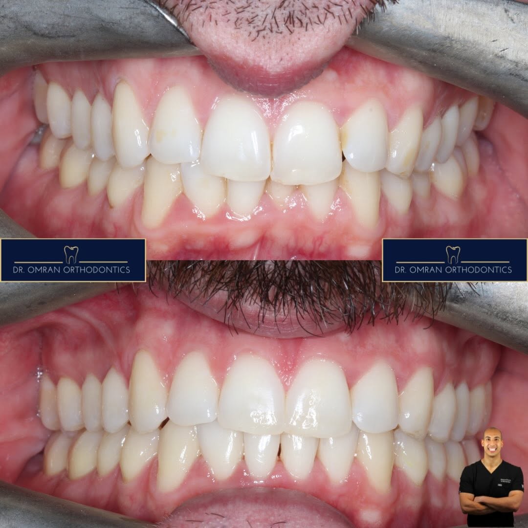 Crowding and overbite, clear aligners
