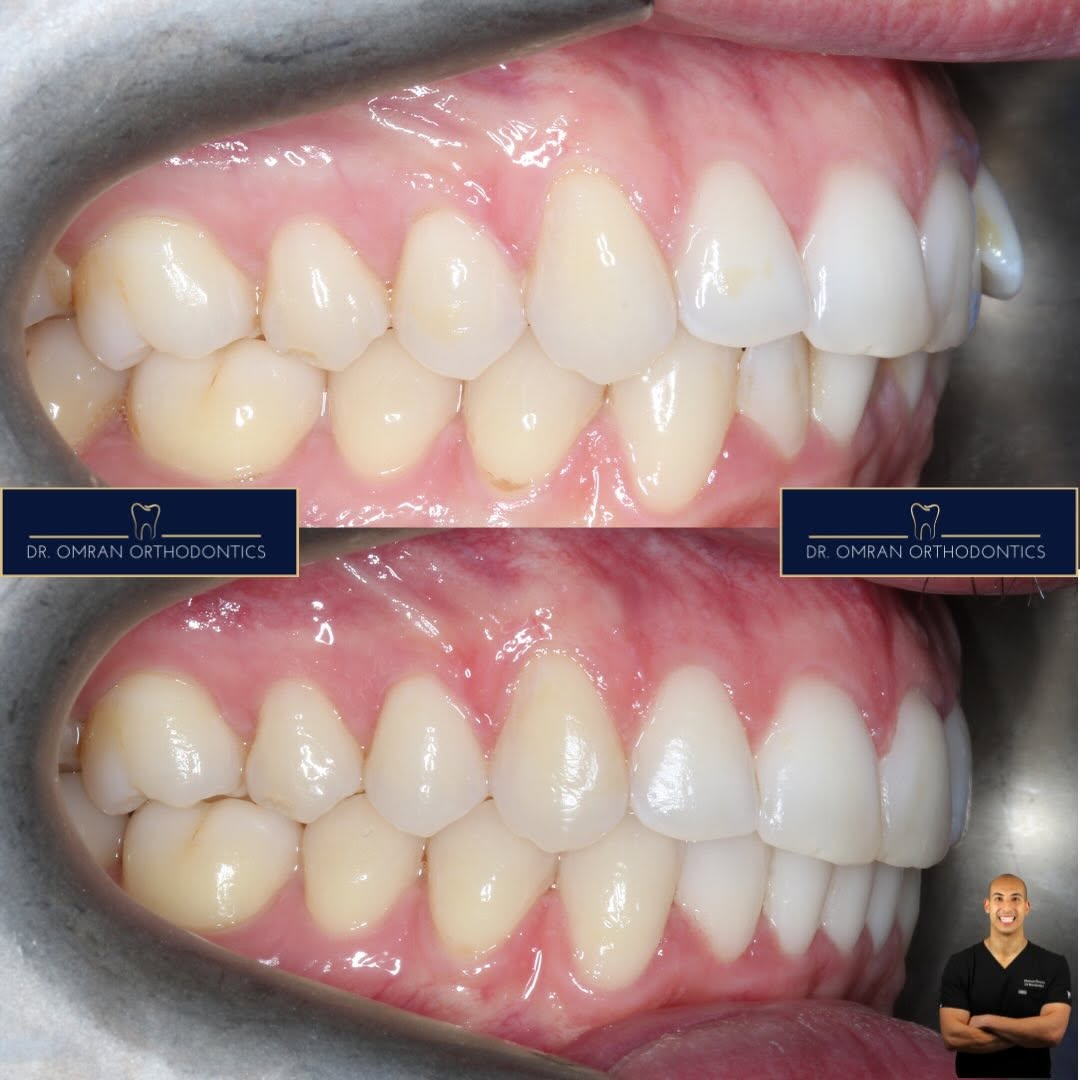 Crowding and overbite, clear aligners