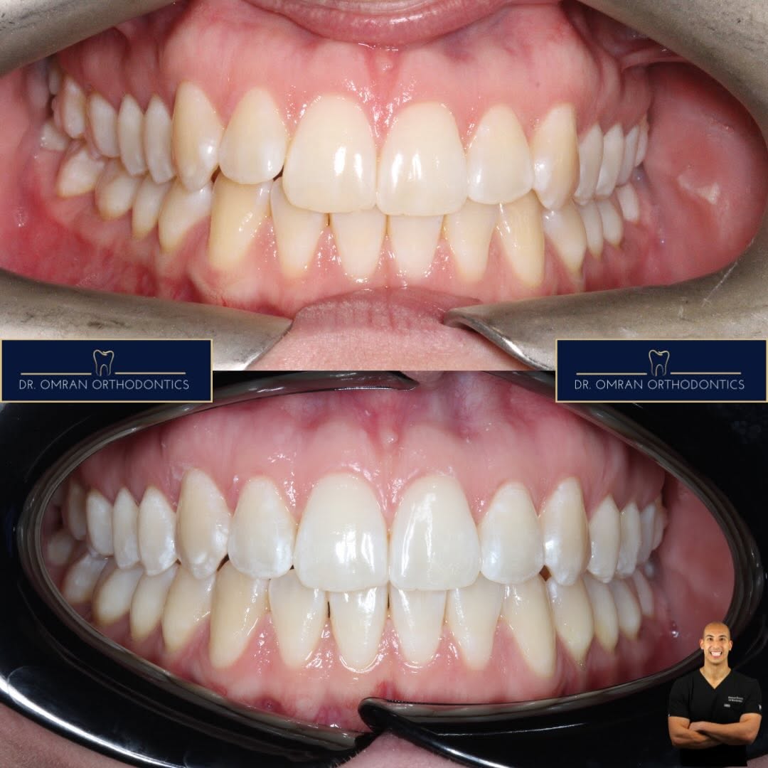 Centre-lines matched after treatment