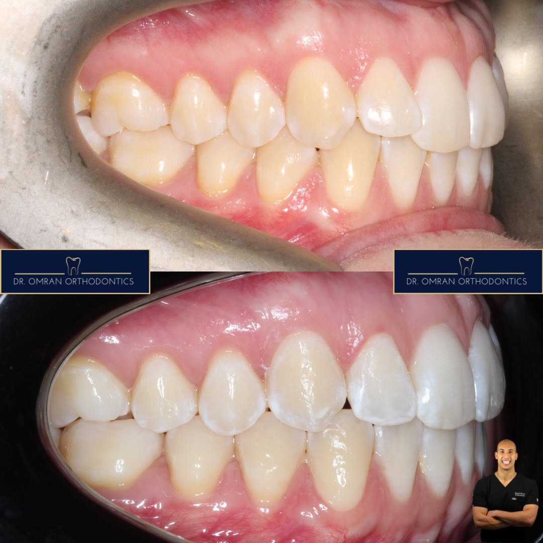 Centre-lines matched after treatment