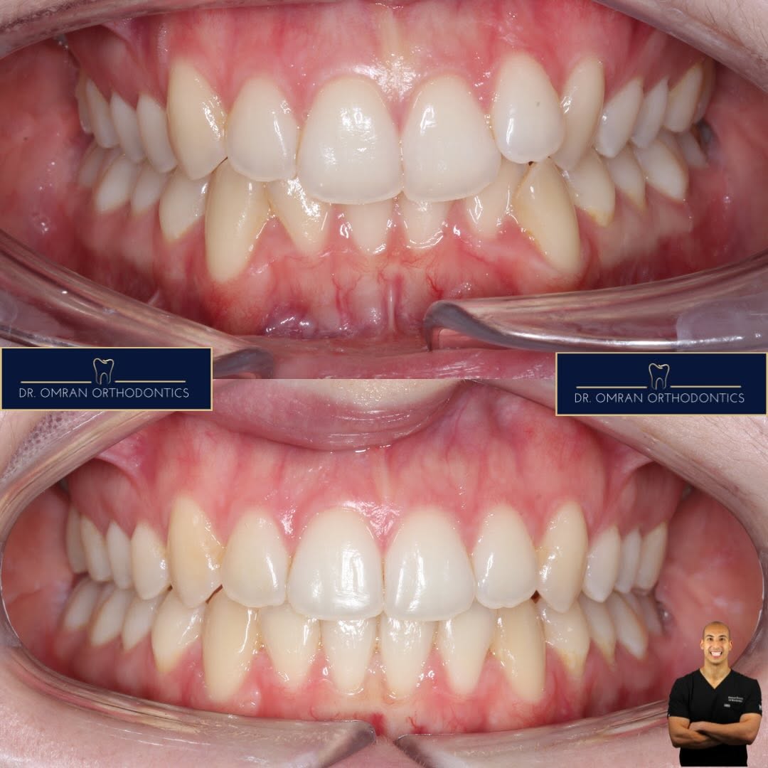 Class II division 2, clear aligners