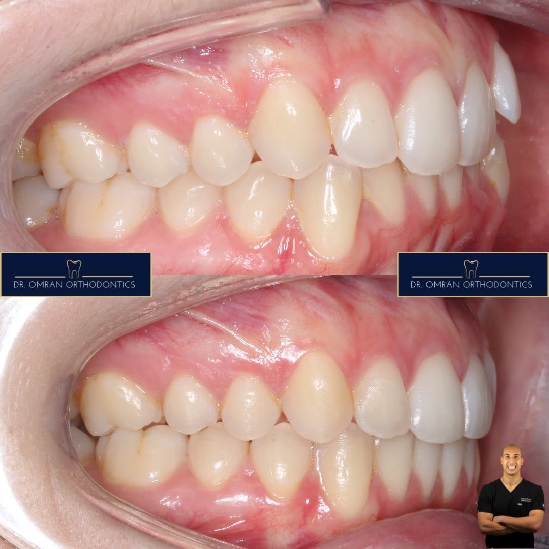 Class II division 2, clear aligners