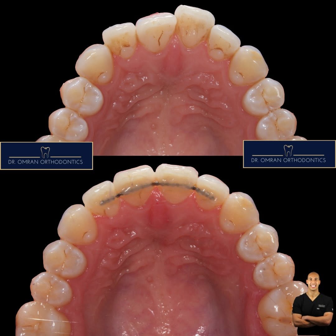 Alignment-only case