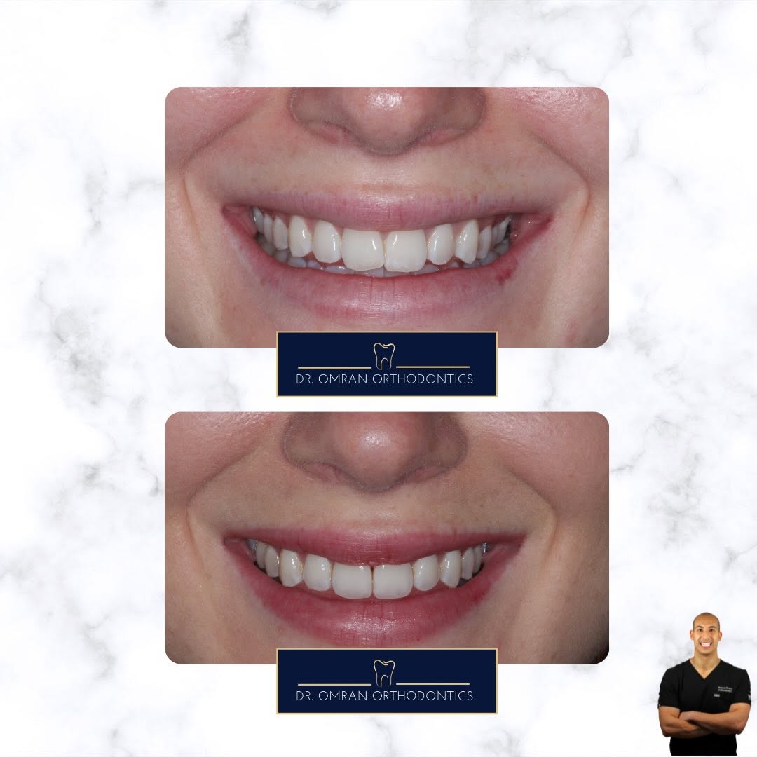 Left-sided crossbite, clear aligners in 10 months