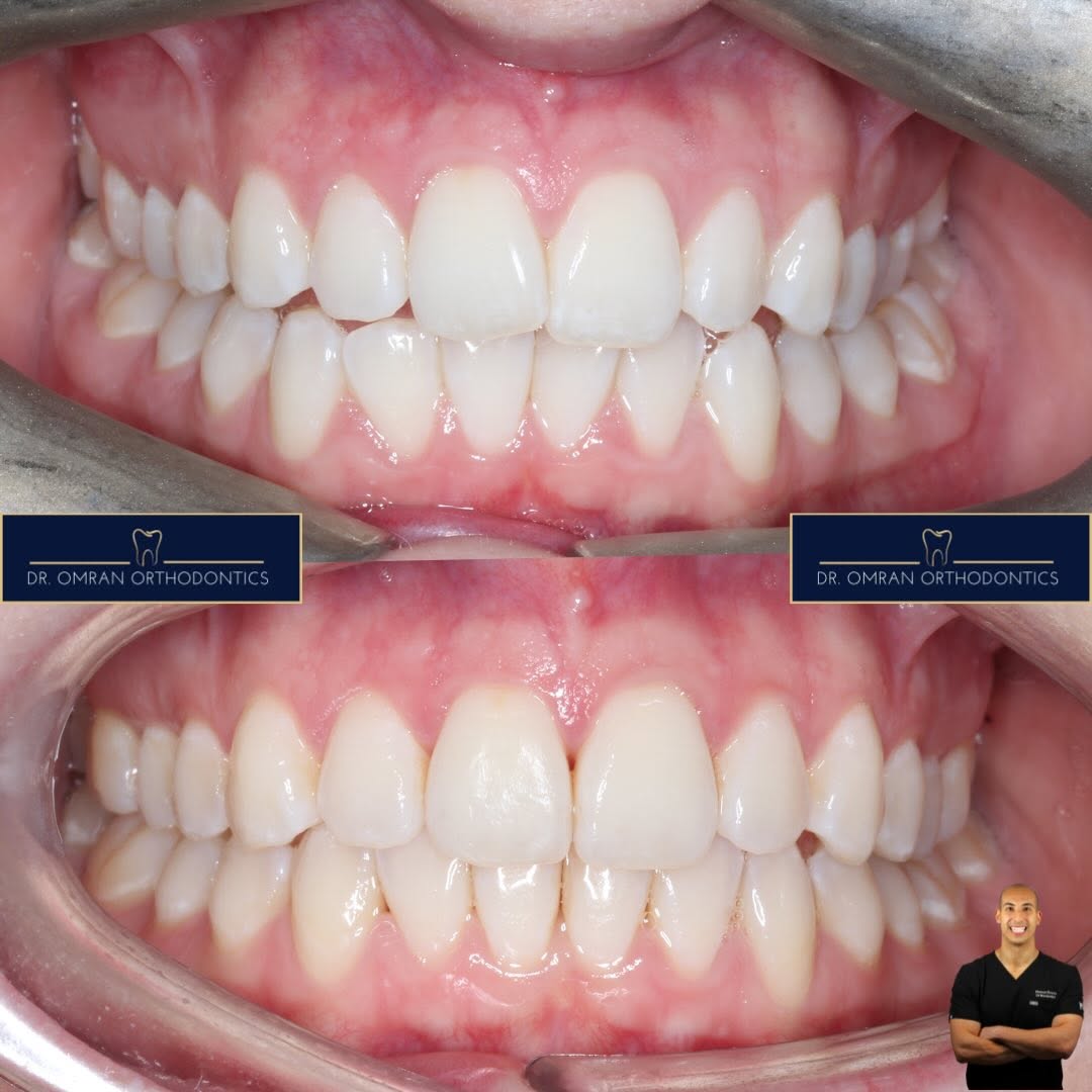 Left-sided crossbite, clear aligners in 10 months