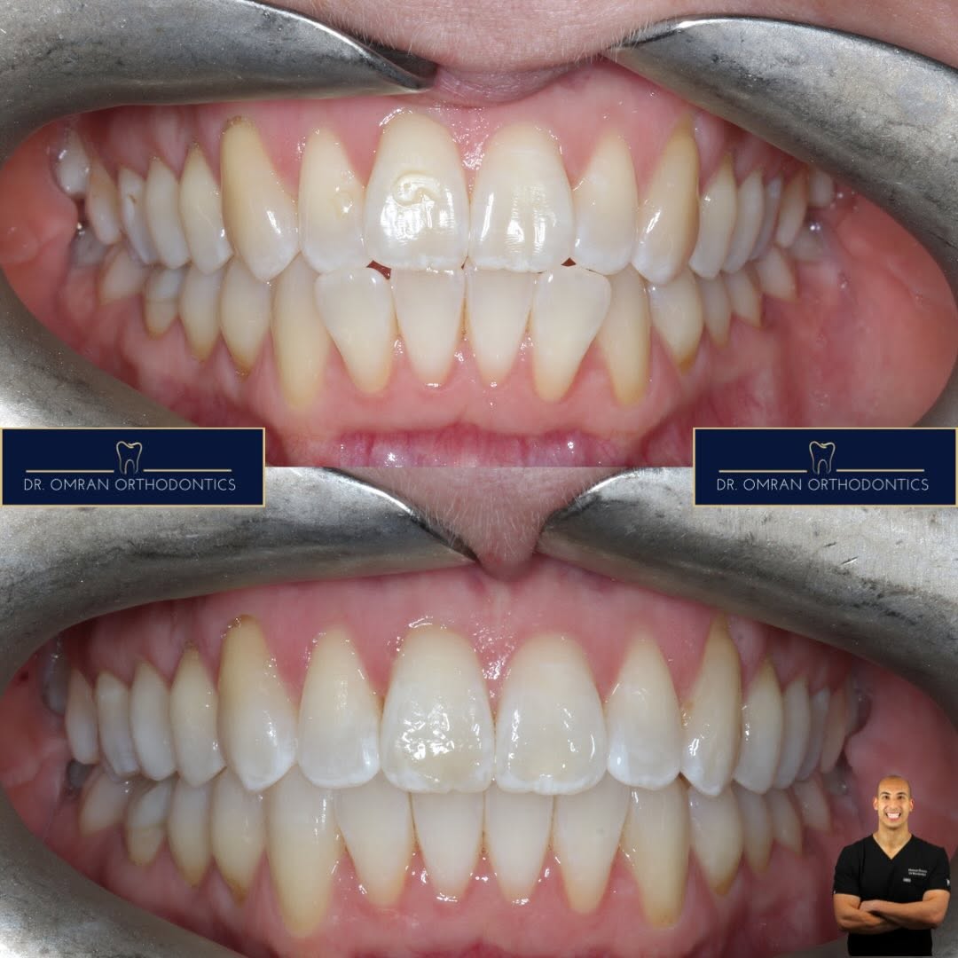 Reverse smile line, about 3 months of clear aligners