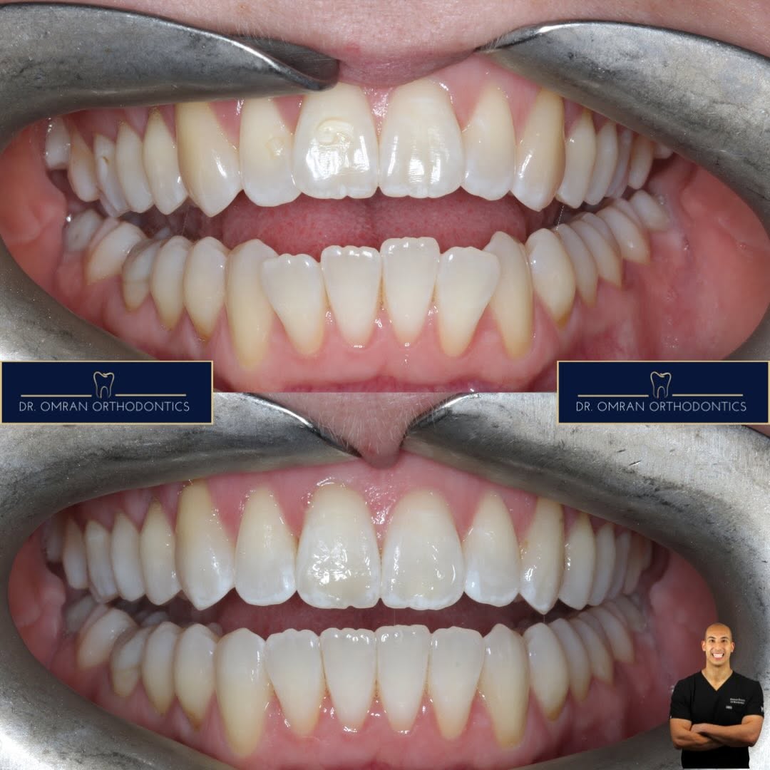 Reverse smile line, about 3 months of clear aligners
